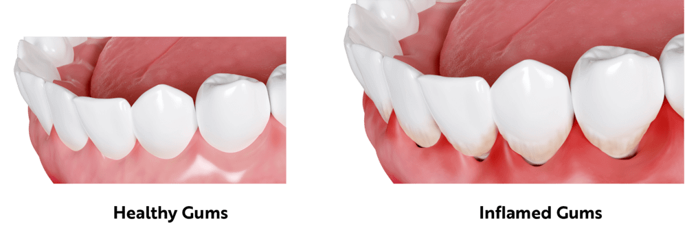 How to Cure Gum Disease Without a Dentist? 11 Effective Home Remedies